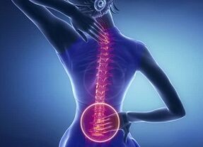 Manifestações de osteocondrose lombar